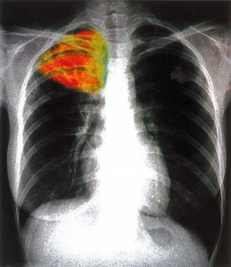 TBC a röntgenképen